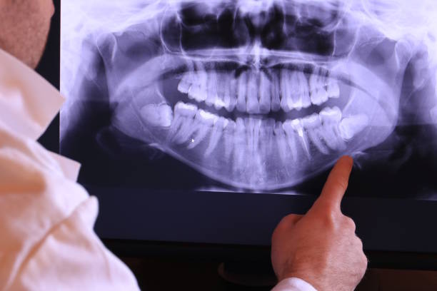 Best Emergency Wisdom Tooth Extraction in Cahokia, IL